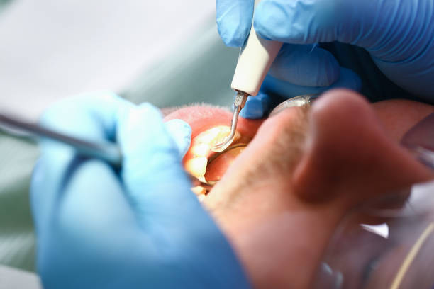 Best Emergency Wisdom Teeth Removal in Lancaster, SC